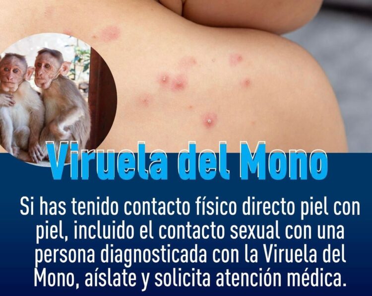 Suman 252 contagios de viruela símica en 20 entidades del país