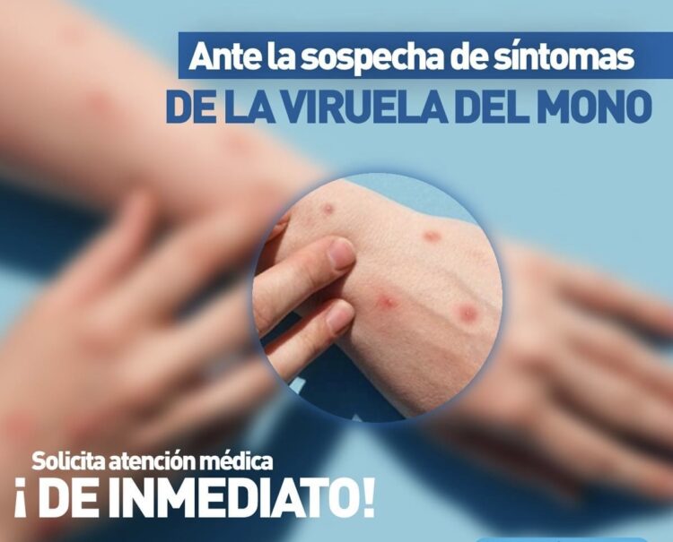 Confirman dos casos de viruela símica en Tampico y Matamoros, Tamaulipas